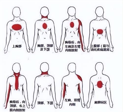 突发心梗死亡明星案例