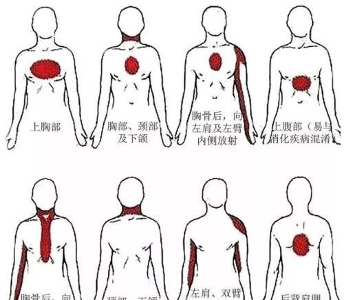 心肌梗死发生