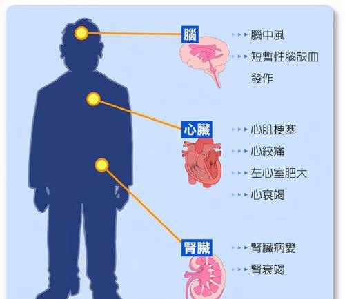 高血压患者怎么测量血压才最准确