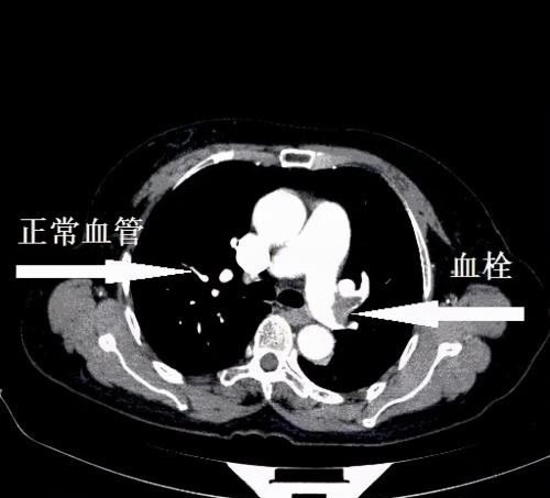 胸闷心梗怎么抢救