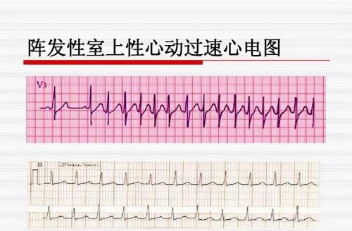 心跳一分钟多少次算快