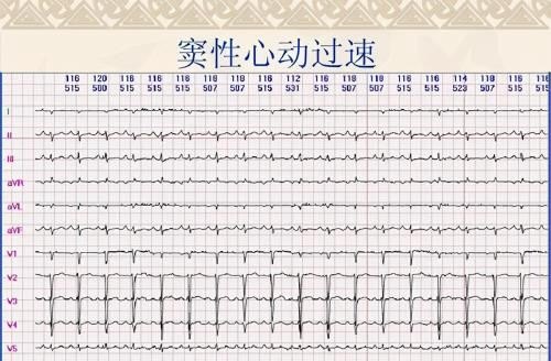 心跳一分钟多少次算快