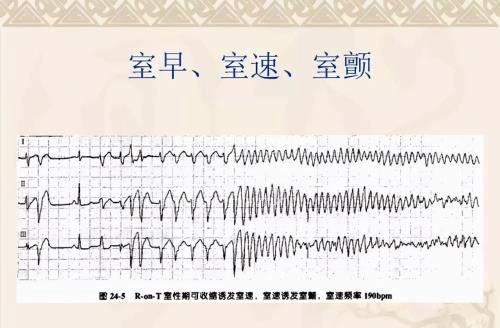 心电图做了没事,可就是心慌