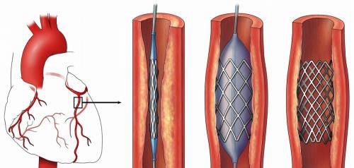 心脏球囊和心脏支架哪个好