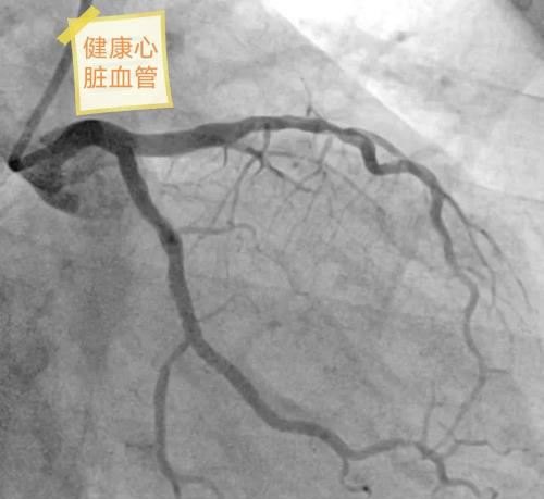 心脏血管一根堵死另外两根狭窄90%