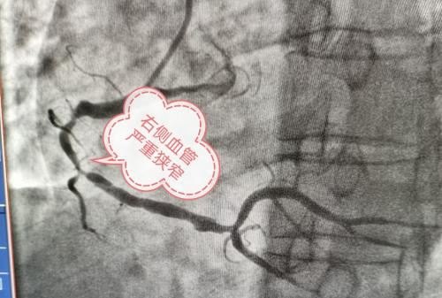 心脏血管一根堵死另外两根狭窄90%