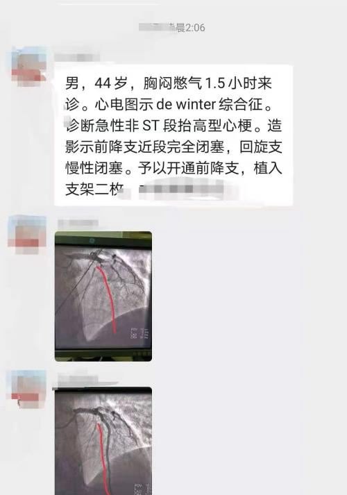 为什么心肌梗死发生在凌晨