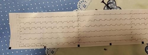 医生在心电图上写什么
