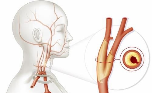 怎么样预防颈动脉斑块