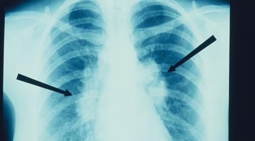 肺纹理增粗的临床意义