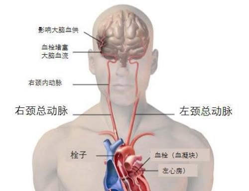 房颤引起的脑血栓大面积堵塞