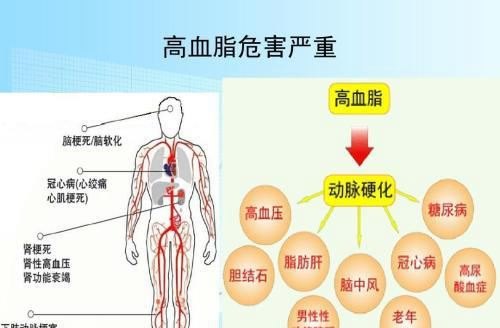 血脂升高可能会造成什么疾病