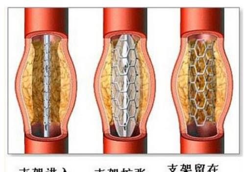 心脏支架的恢复期多久?