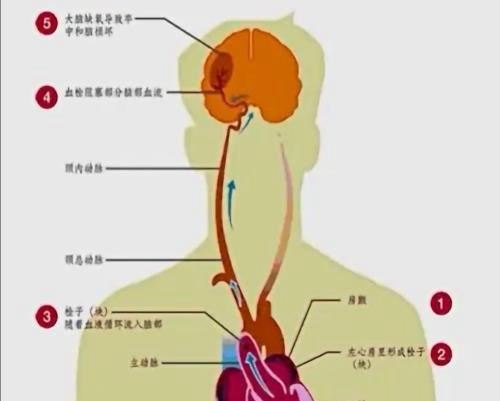 我国脑梗病人的比例