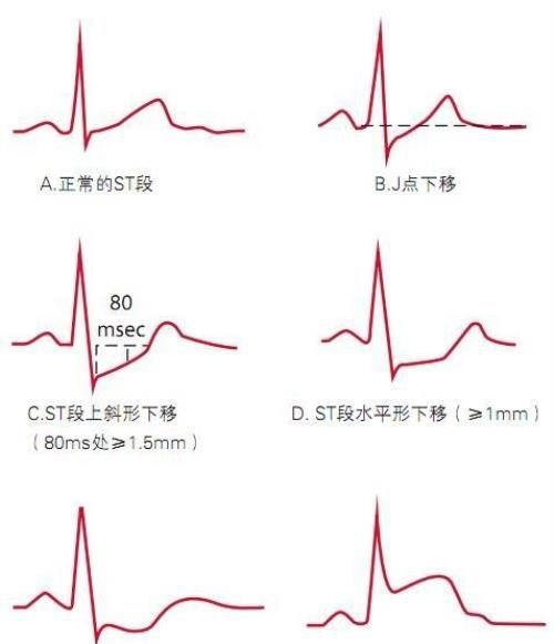 28岁心电图心肌缺血