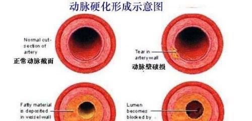 心脏血管狭窄40%是否终身用药