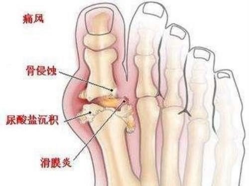 血糖高血压高血脂高胆固醇高四高怎么治疗