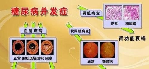 糖尿病人怎么吃饭血糖不会高