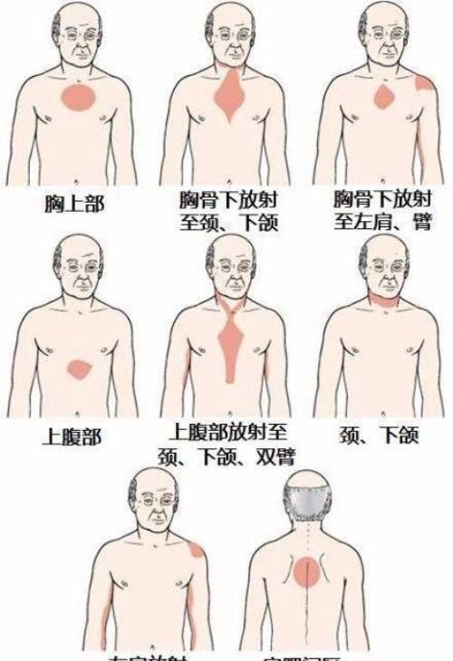 心肌缺血是什么病种