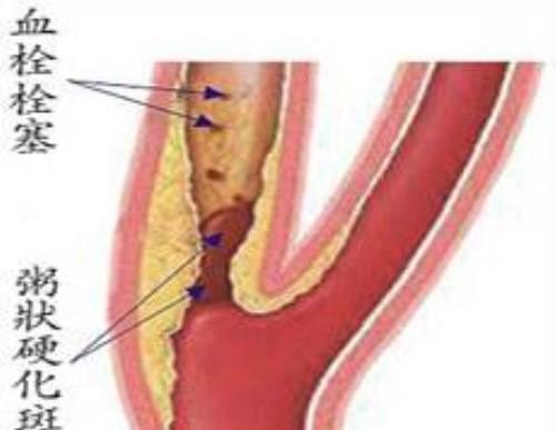 颈动脉斑块中药怎样消除最好的方法