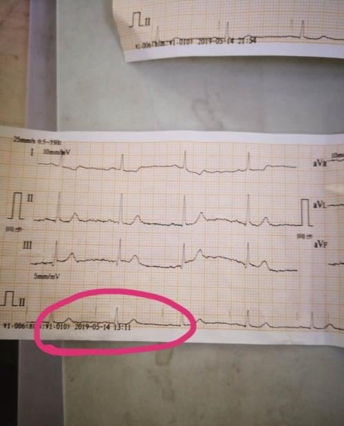 为什么早上下午的心电图不一样
