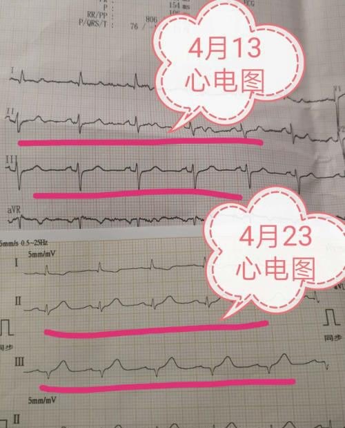 心电图心脏正常是不是可以排除心梗