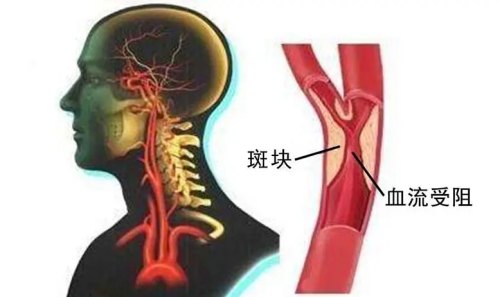 颈动脉有斑块怎么治?