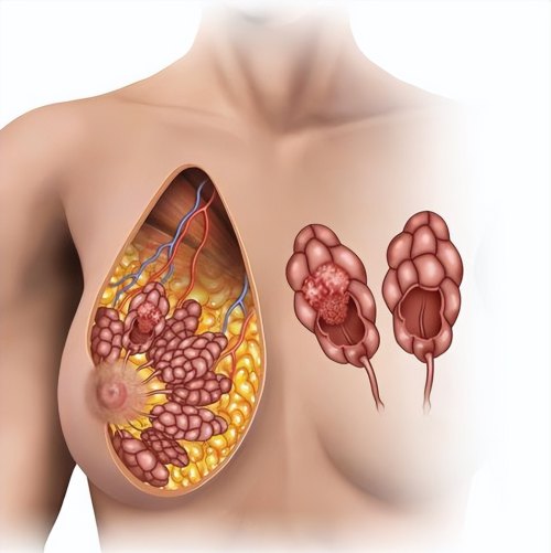 乳腺癌的典型表现