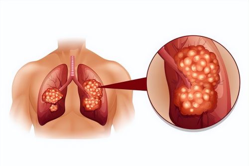3个容易癌变的结节,中医详细讲解图
