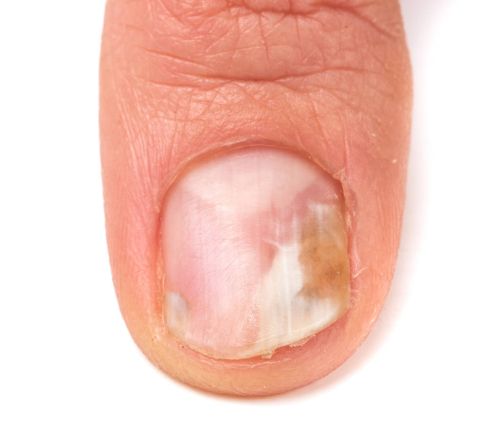 指甲若长成3个样子，或是癌或疾病的信号，需要引起重视