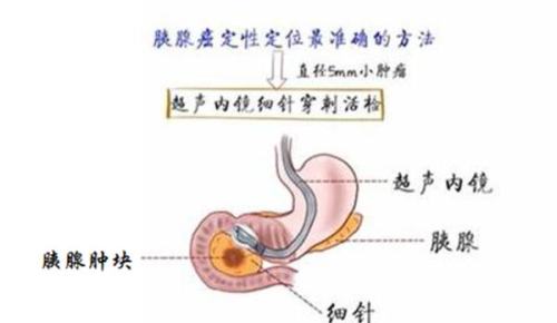 为什么胰腺癌被称为“癌中之王”，出现这些症状要当心