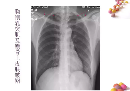 正常x片胸片(正常胸片x光片图及讲解)