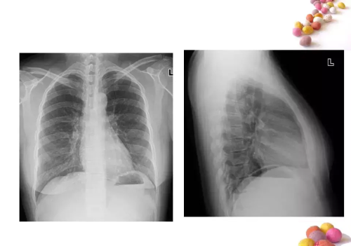 正常x片胸片(正常胸片x光片图及讲解)