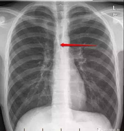 x线胸片模板(x线胸片常见病图解)