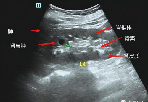 超声的回声强度(超声 强回声)