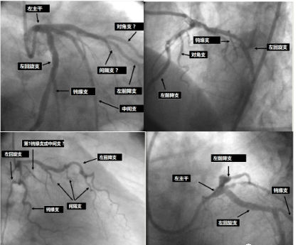简述冠状动脉造影过程及造影识别方法(简述冠状动脉造影过程及造影识别方法)