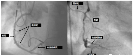 简述冠状动脉造影过程及造影识别方法(简述冠状动脉造影过程及造影识别方法)