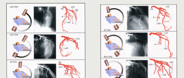 简述冠状动脉造影过程及造影识别方法(简述冠状动脉造影过程及造影识别方法)