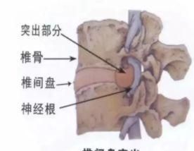 调整脊柱侧弯瑜伽理疗序列是什么(调整脊柱侧弯瑜伽理疗序列有哪些)