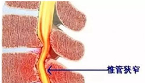 调整脊柱侧弯瑜伽理疗序列是什么(调整脊柱侧弯瑜伽理疗序列有哪些)