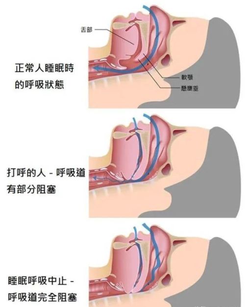 睡觉打呼是哪些因素引起的(睡觉打呼是哪些因素引起的原因)