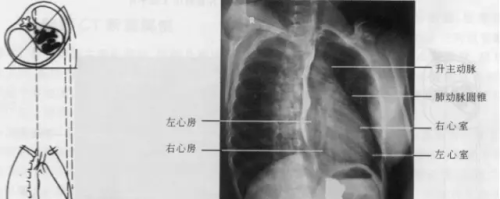 手把手教你读懂胸部x线(胸部x线结果解读)