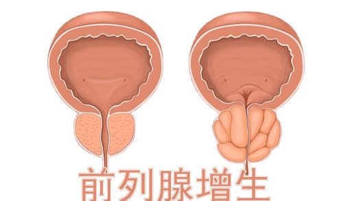 男性雄激素越旺盛越好吗？医生提醒：60岁后，或将面临3大问题！