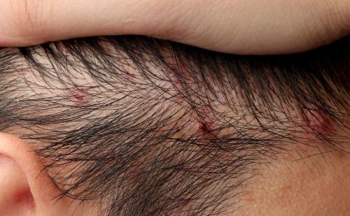 皮肤病容易反复，毛囊炎的发生，或与这些因素有关，尽量避免