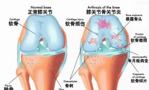 等老了再“养”膝盖就晚了！提醒：保护膝关节，从这4种方法开始