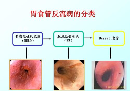 胃食管反流病患者在生活中应该忌吃什么？