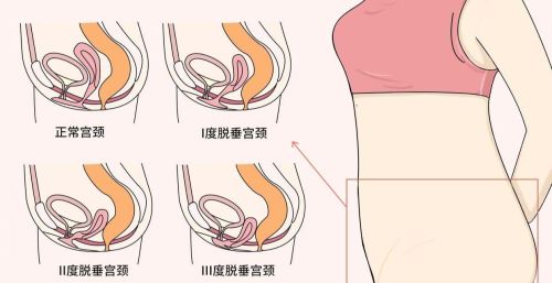 子宫脱垂是什么病？为什么有些女性会得这个病？或和这3点有关