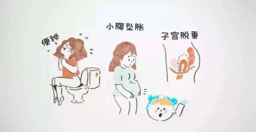 子宫脱垂是什么病？为什么有些女性会得这个病？或和这3点有关