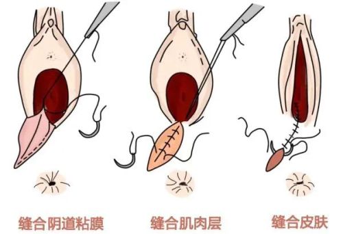 顺产最怕的不是侧切而是撕裂，孕妈妈如何避免？