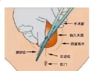 顺产最怕的不是侧切而是撕裂，孕妈妈如何避免？